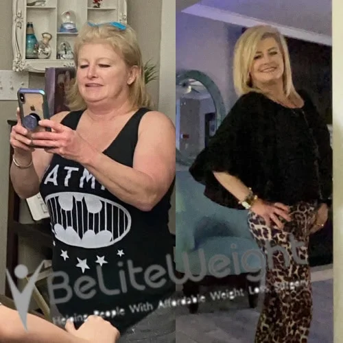 Weight Loss Surgery Gastric Sleeve before and after